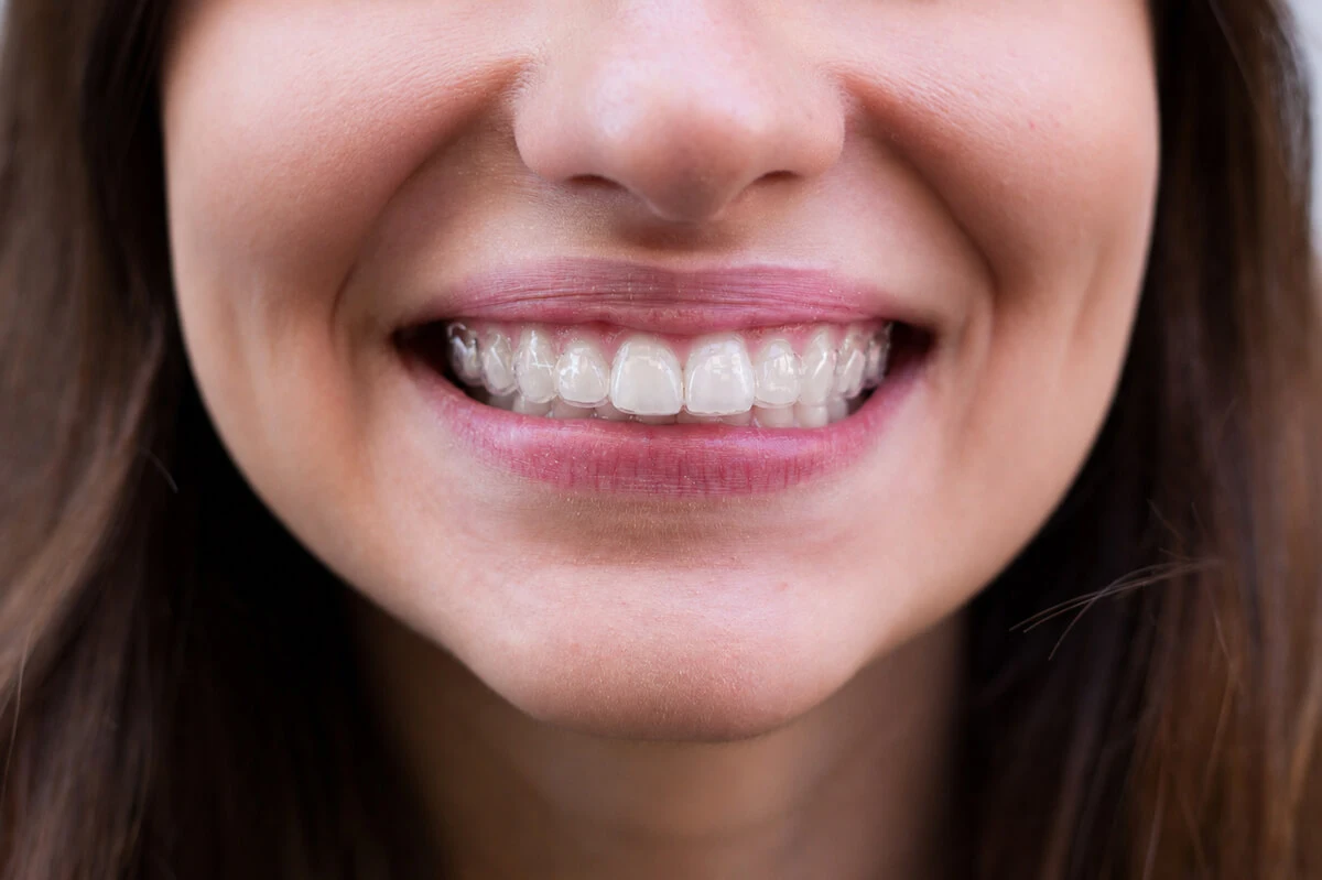 Sorriso com alinhador invisível